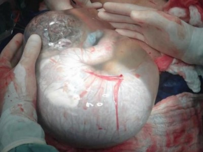 התינוק שלא ידע שהוא נולד: נותר בתוך שק מי השפיר