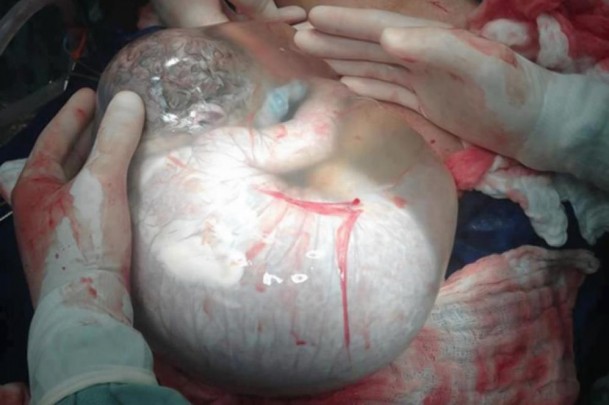 התינוק שלא ידע שהוא נולד: נותר בתוך שק מי השפיר