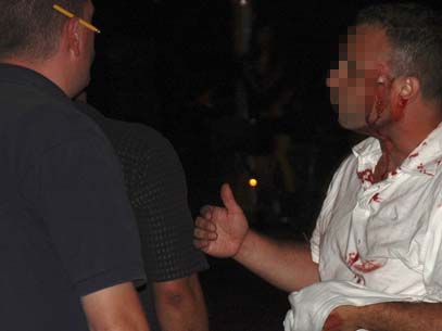 נצרת עלית: עובד עירייה בן 68 הותקף באלימות ונפגע בראשו