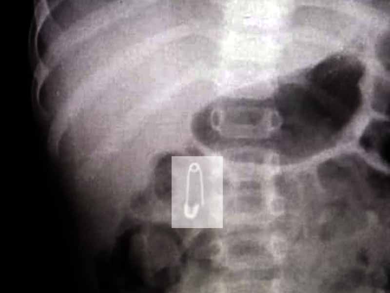 תצלום רנטגן של הפעוט עם הסיכה המסוכנת. צילום: מרכז רפואי העמק